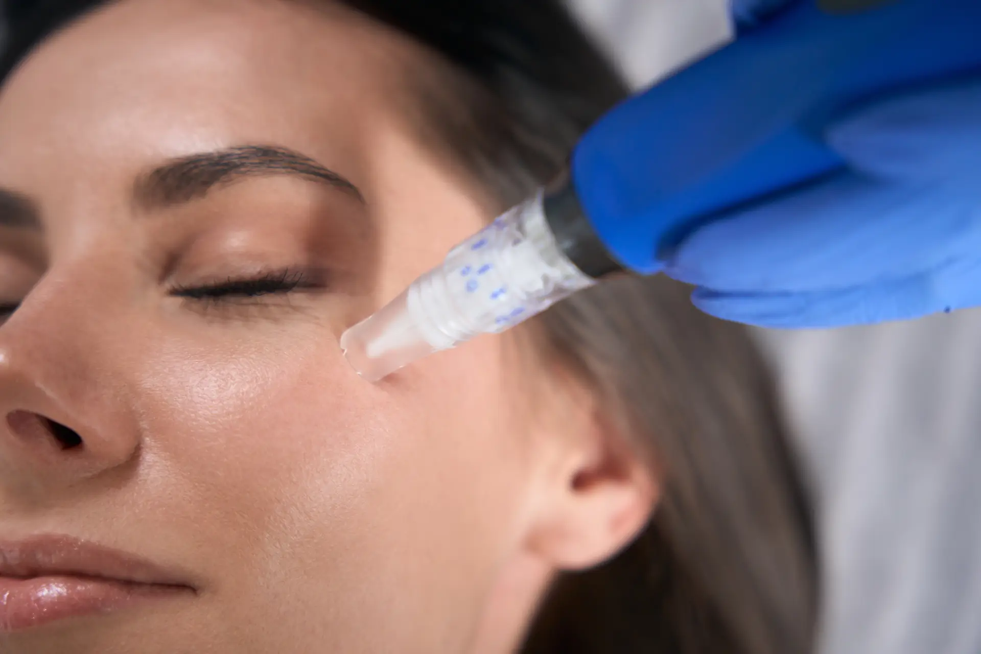 A person getting Microneedling Treatment in Centennial, CA | Gallery | Refine Medspa