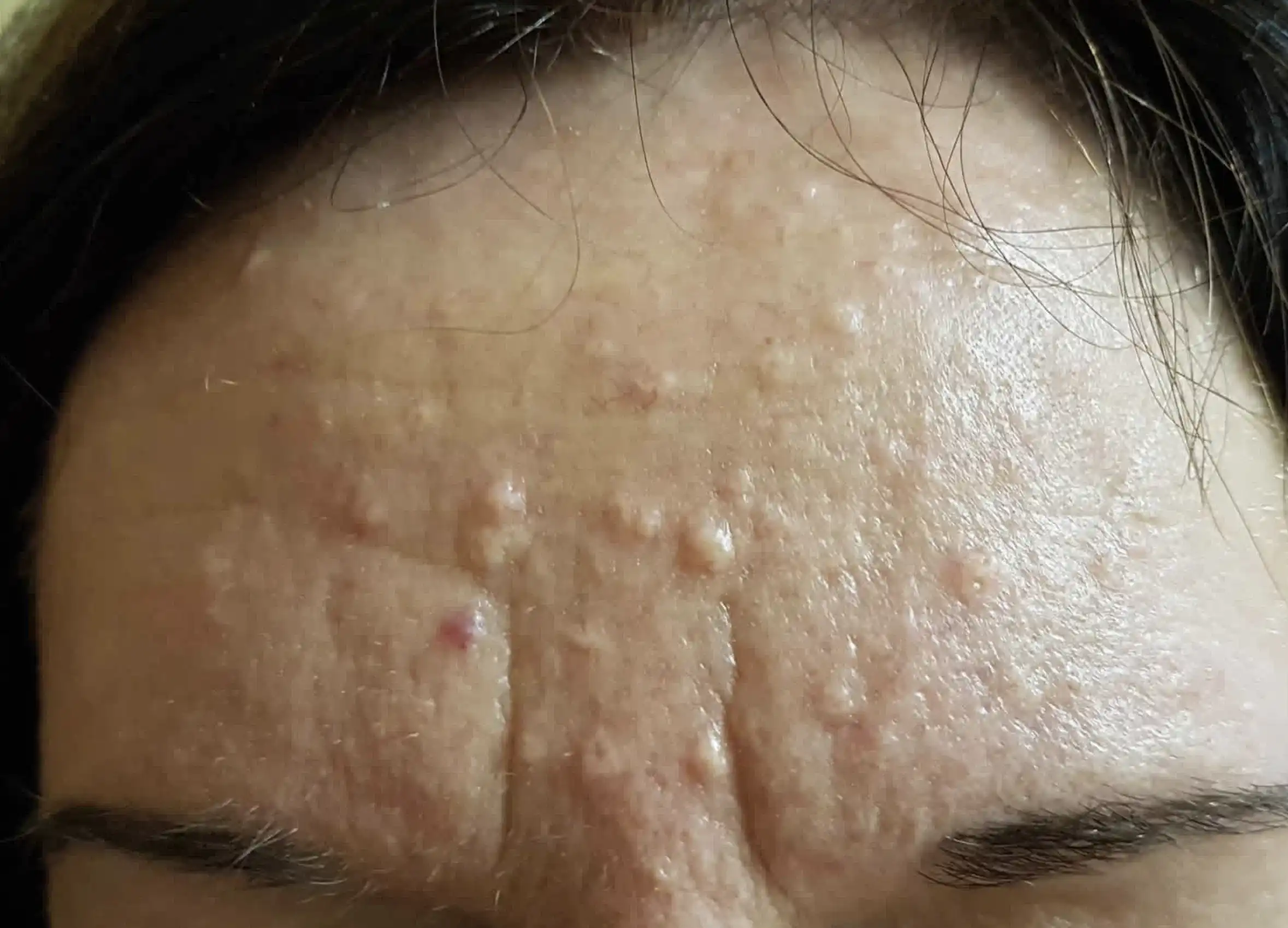 Hyperplasia removal treatment at Refine Med Spa in Centennial, CO.