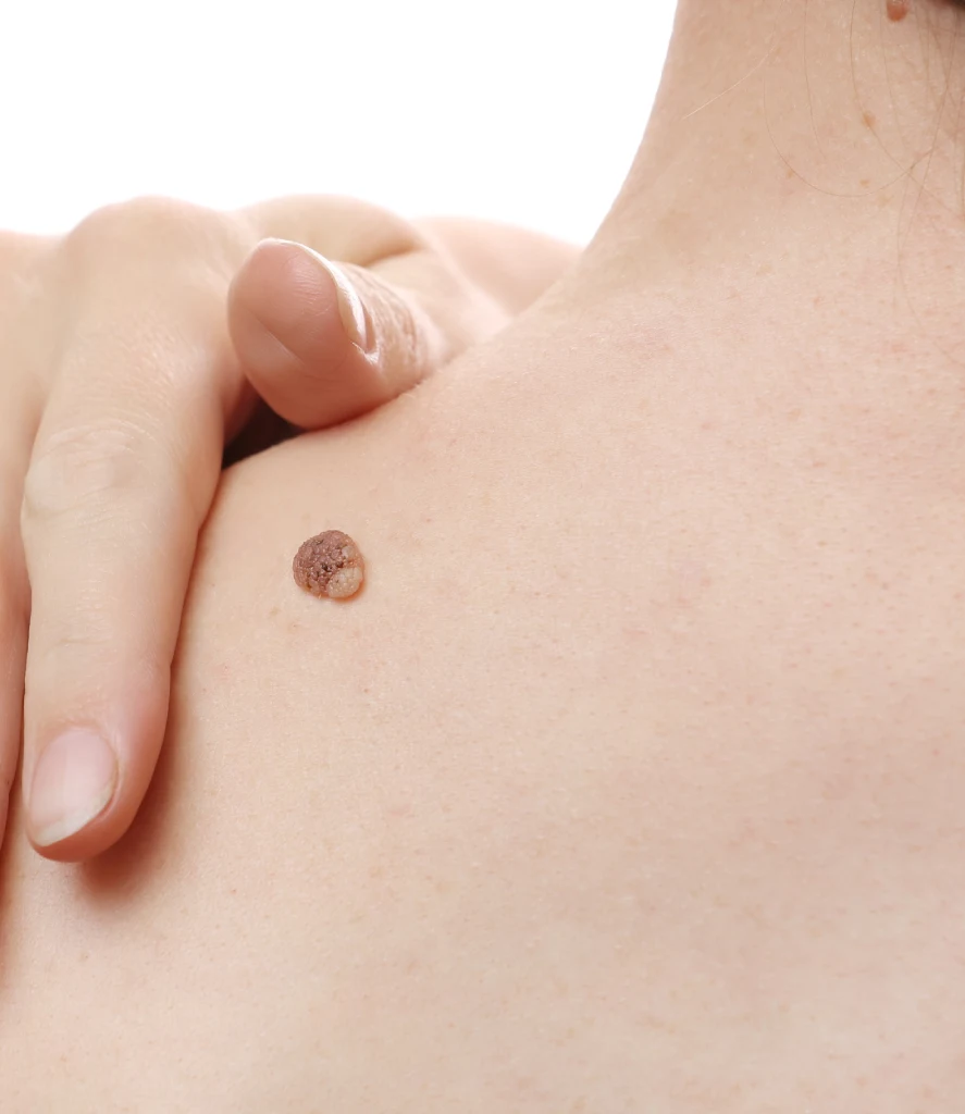 Close-up of a raised wart on a person's upper back, with a hand gently pointing to the area. The image illustrates a typical case for Permanent Wart Removal in Centennial CO at Refine Med Spa.