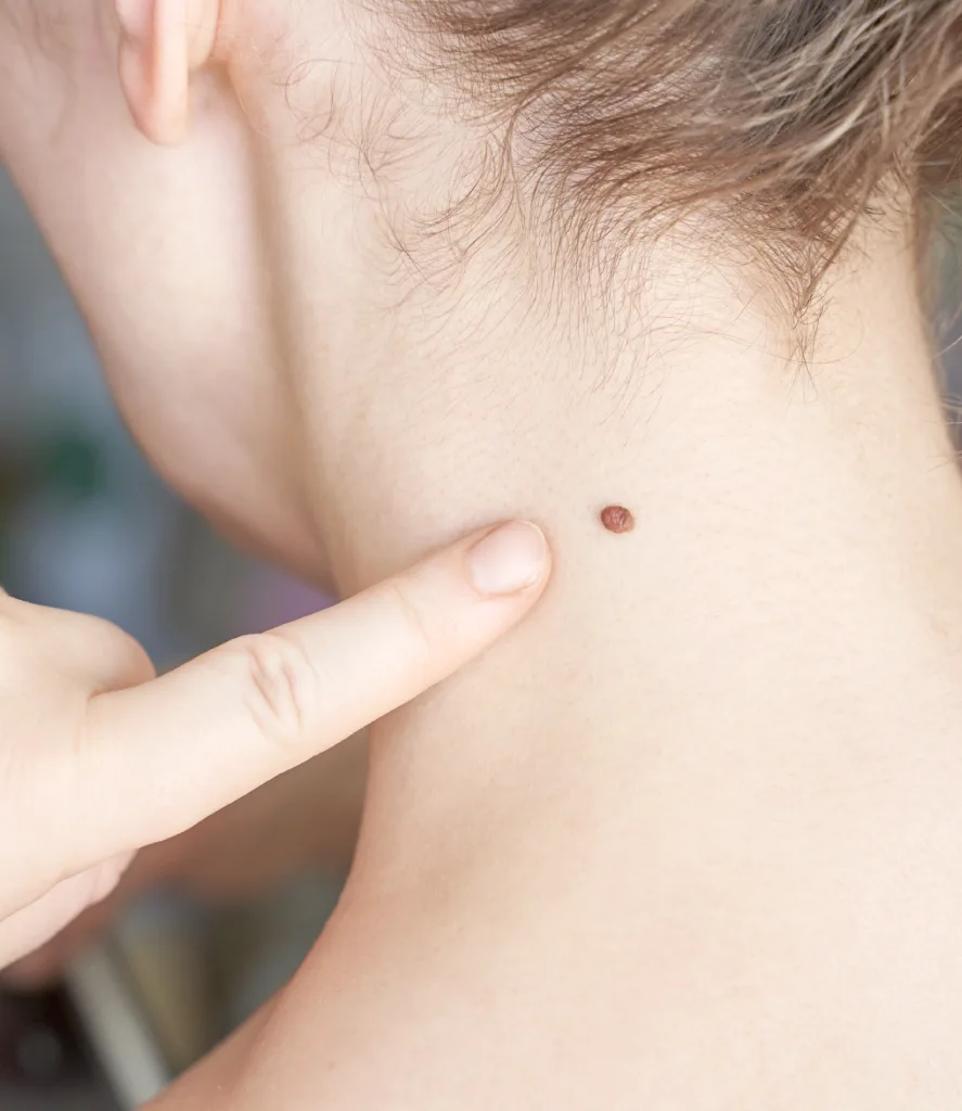 Close-up of a raised wart on a person's upper back, with a hand pointing to it. Illustrates a typical case for Permanent Wart Removal at Refine Med Spa in Centennial, CO.