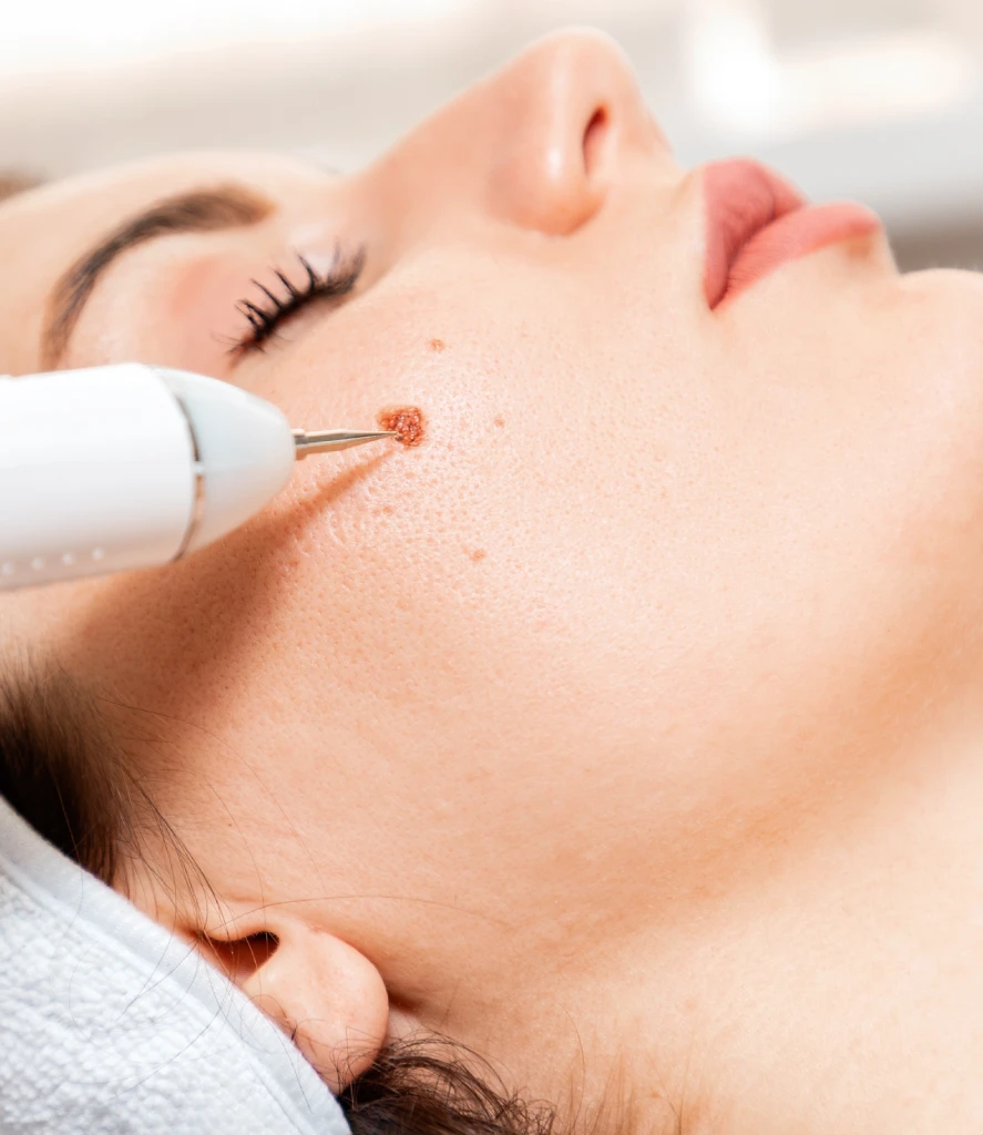 Permanent Wart Removal Treatment in Centennial Co | Refine Med Spa