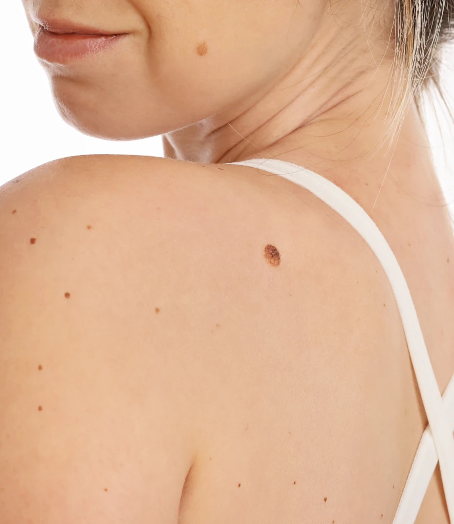Woman with multiple skin tags and moles on her shoulder and neck, wearing a white tank top. The image represents a typical candidate for Skin Tag Removal in Centennial CO at Refine Med Spa.