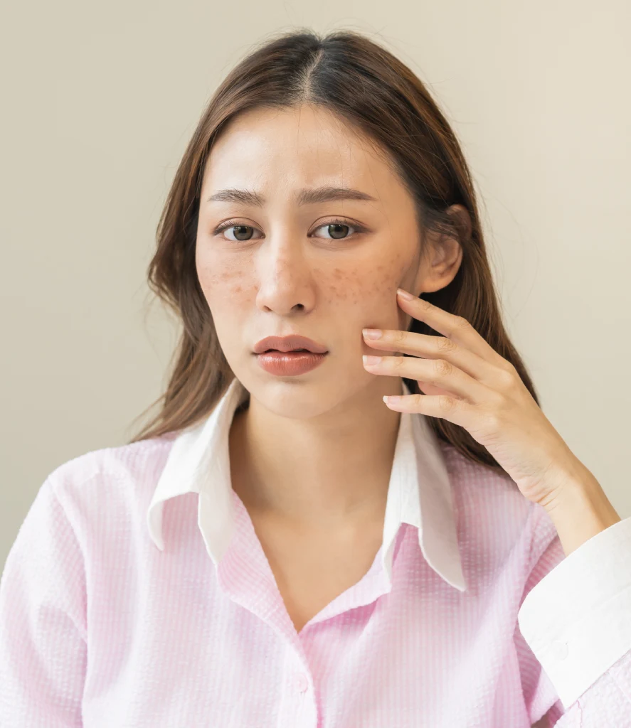 Woman with visible facial pigmentation and redness gently touching her cheek while looking concerned. The image represents a common skin concern treated through Vascular and Pigmentation Correction in Centennial CO at Refine Med Spa.