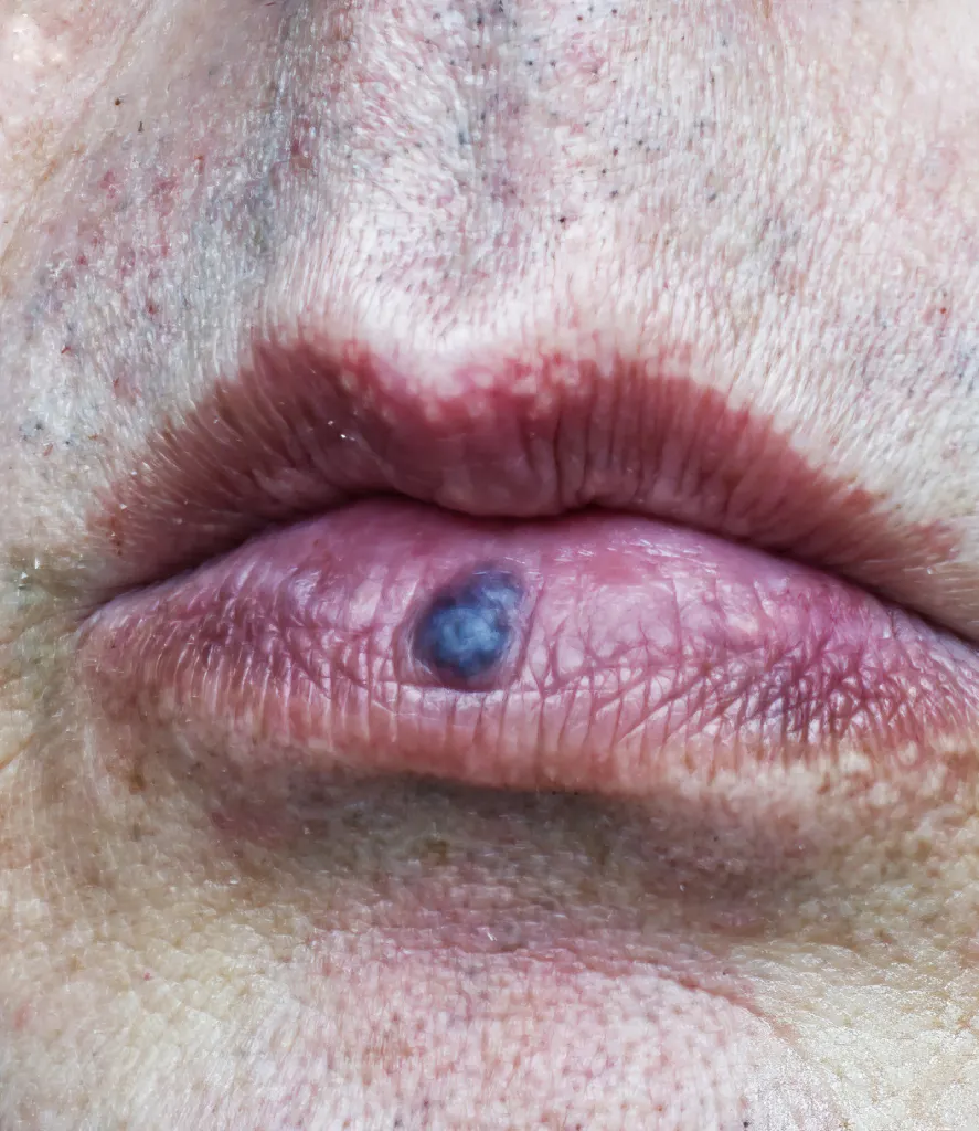 Venous Lake Removal in Centennial, CO, at Refine Med Spa