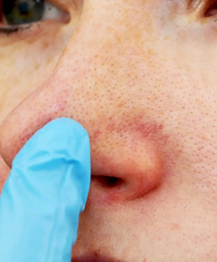 Vascular and pigment correction treatment at Refine Med Spa in Centennial, CO.