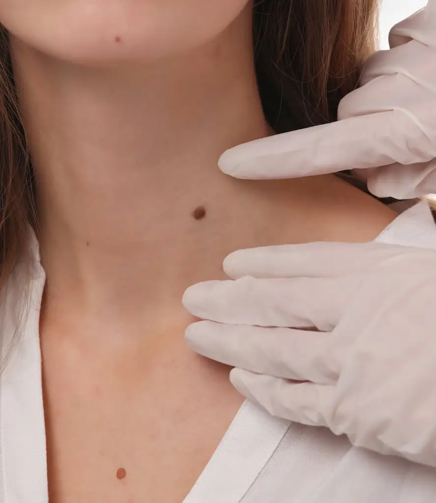 A person with gloves touching a neck of women for Skin Tag Removal in Centennial, CA | Refine Med spa