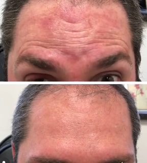 Forehead before and after wrinkle reduction