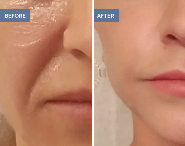 Before and after facial skin smoothing