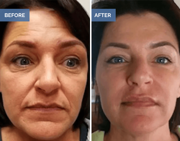 Before and after facial wrinkle reduction