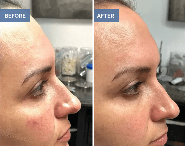Before and after facial profile showing smoother nose