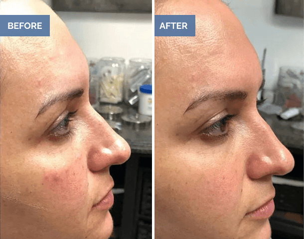 Side-by-side before and after facial treatment