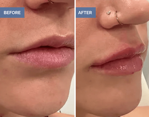 Before and after subtle lip augmentation