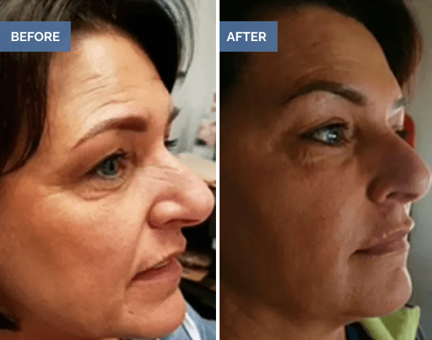 Side-by-side profile before and after cosmetic improvements