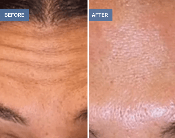 Forehead wrinkle reduction before and after
