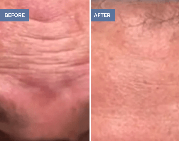 Forehead wrinkles before and after treatment