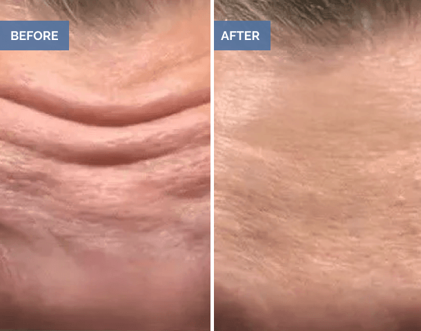 Before and after forehead wrinkle reduction