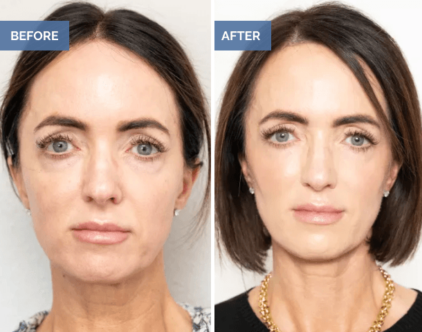 Woman before and after facial rejuvenation