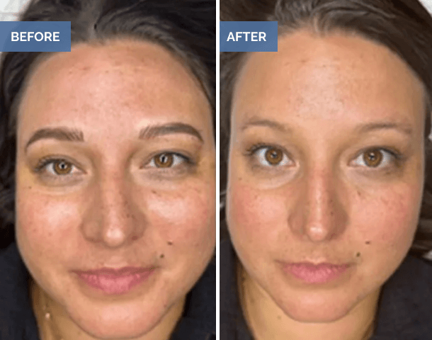 Before and after facial skin tone improvement
