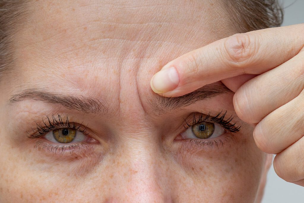 Dysport for Forehead Lines