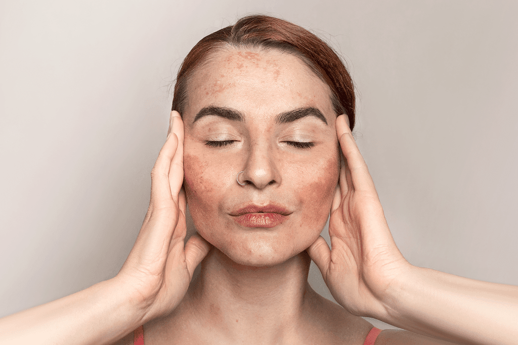 Freckled woman massaging temples, eyes closed
