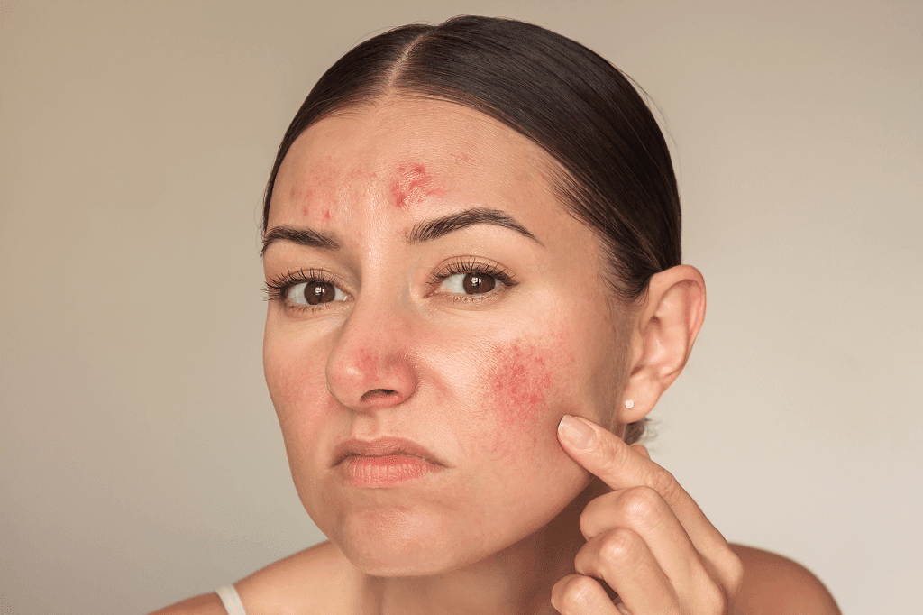 Woman touching inflamed acne on cheek