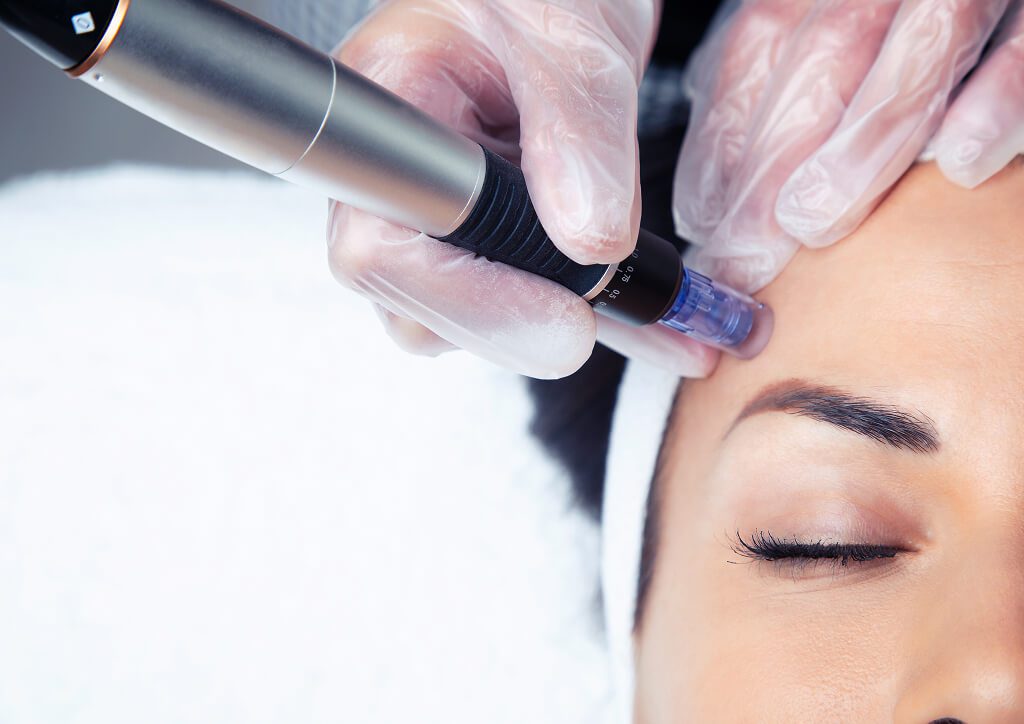 Close-up microneedling treatment on woman's forehead