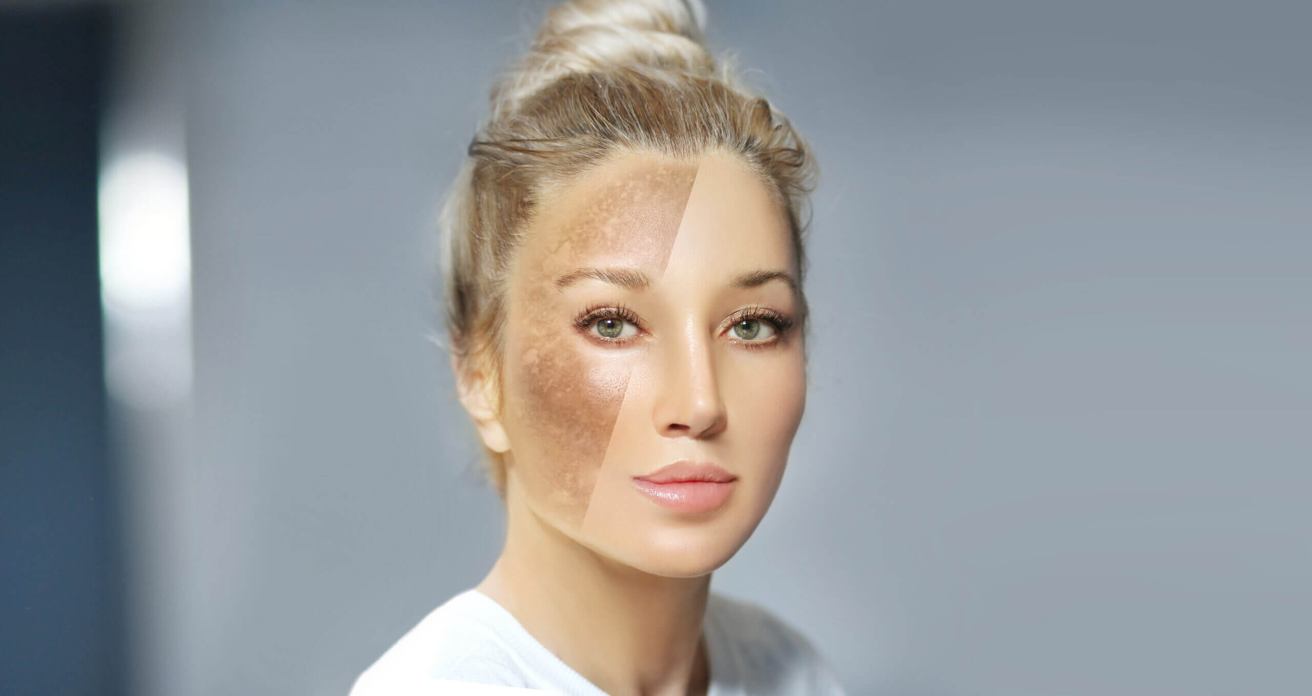 Split-face woman showing pigmentation and clear skin